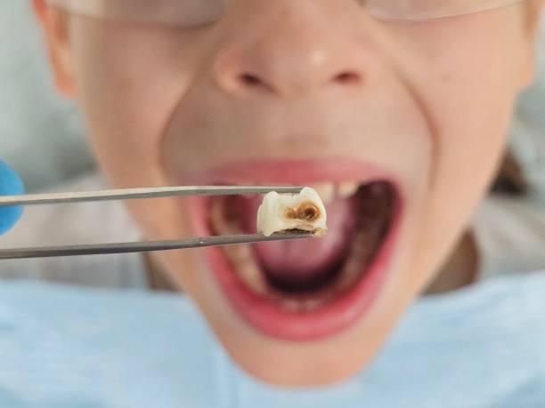 Best Emergency Treatment for Oral Infections in Lakes Of The Four Seasons, IN